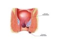 piles-specialist-doctor-in-indirapuram-small-0