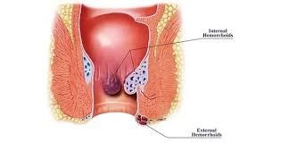 piles-specialist-doctor-in-indirapuram-big-0