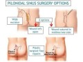 pilonidal-sinus-treatment-in-ghaziabad-small-0