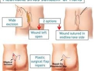 Pilonidal Sinus treatment in Ghaziabad