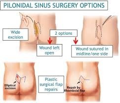 pilonidal-sinus-treatment-in-ghaziabad-big-0