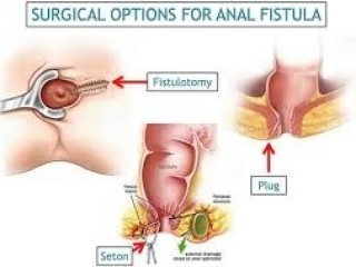 Best Doctor For Fistula Treatment in Indirapuram