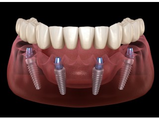 All on 4 dental implants tijuana Mexico