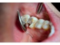 full-dentures-christchurch-small-1