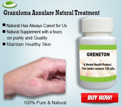 herbal-supplements-for-granuloma-annulare-big-0