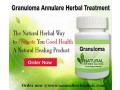 herbal-product-for-granuloma-annulare-small-0