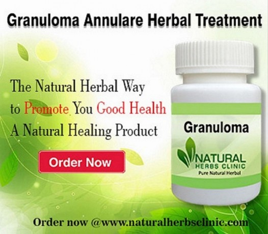 herbal-product-for-granuloma-annulare-big-0