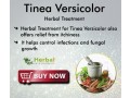 herbal-supplement-for-tinea-versicolor-small-0