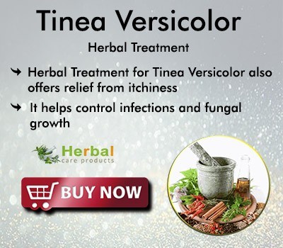 herbal-supplement-for-tinea-versicolor-big-0