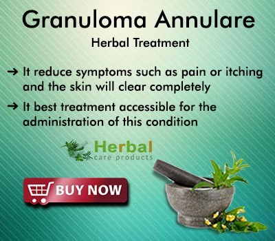 herbal-products-for-granuloma-annulare-big-0