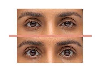 Upneeq®: Revolutionary Treatment for Acquired Ptosis