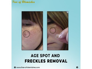 Use Free-of-Blemishes Remove blemishes from skin permanently