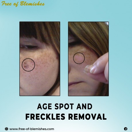 use-free-of-blemishes-remove-blemishes-from-skin-permanently-big-0