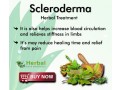 herbal-treatment-for-scleroderma-small-0