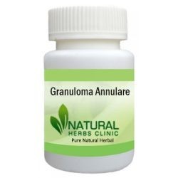 herbal-remedies-for-granuloma-annulare-big-0