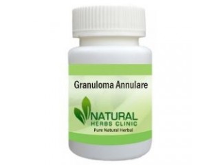 Herbal Supplement for Granuloma Annulare