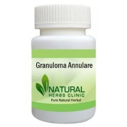 natural-remedies-for-granuloma-annulare-big-0
