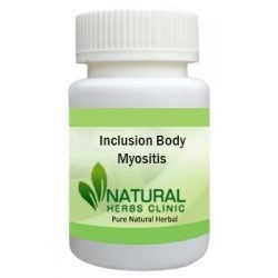 home-remedies-for-inclusion-body-myositis-big-0