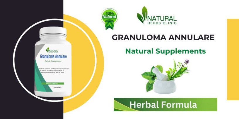 best-herbal-supplements-for-granuloma-annulare-natural-cure-big-0