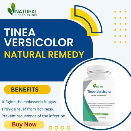 safe-and-effective-tinea-versicolor-natural-remedies-big-0