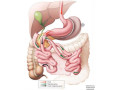the-laparoscopic-duodenal-switch-performed-at-the-nicholson-clinic-small-0