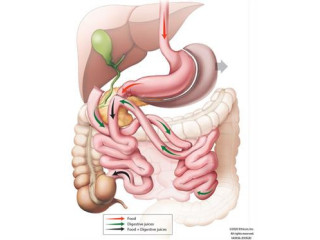 The Laparoscopic Duodenal Switch performed at the Nicholson Clinic