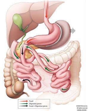 the-laparoscopic-duodenal-switch-performed-at-the-nicholson-clinic-big-0