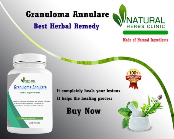 natural-herbal-remedies-for-granuloma-annulare-big-0