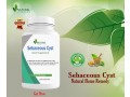 sebaceous-cyst-home-remedy-by-natural-herbs-clinic-small-0