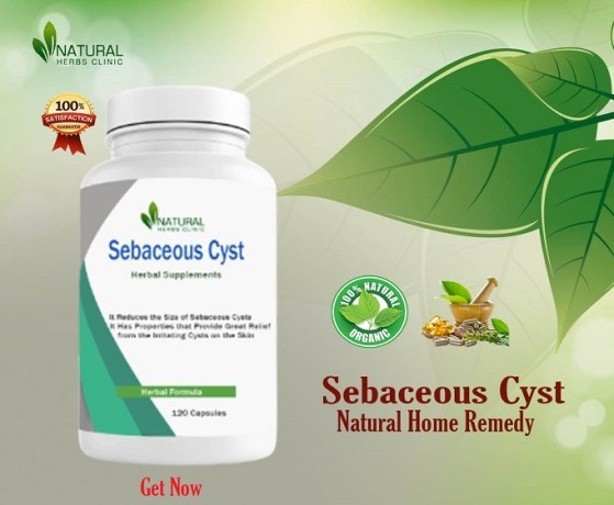 sebaceous-cyst-home-remedy-by-natural-herbs-clinic-big-0