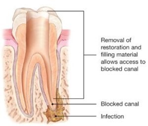 smile-saviors-capitol-endodontics-your-tooth-infection-specialist-big-0