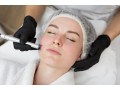 new-paltz-and-kingston-laser-skin-resurfacing-treatment-small-0