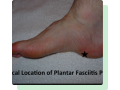 plantar-fasciitis-heel-pain-treatment-small-0