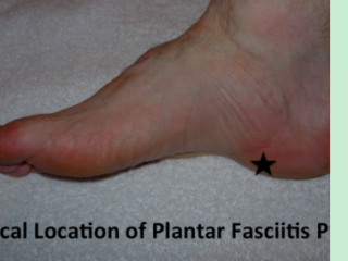 Plantar Fasciitis Heel Pain Treatment