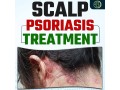 best-natural-scalp-psoriasis-treatment-no-steroids-needed-small-0