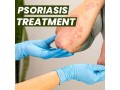 best-natural-scalp-psoriasis-treatment-no-steroids-needed-small-2