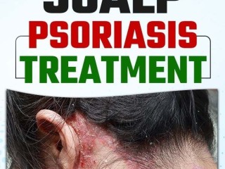 Best Natural Scalp Psoriasis Treatment: No Steroids Needed!