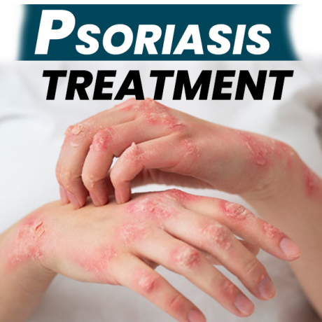 best-natural-scalp-psoriasis-treatment-no-steroids-needed-big-1