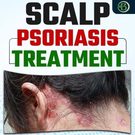 best-natural-scalp-psoriasis-treatment-no-steroids-needed-big-0