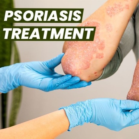 best-natural-scalp-psoriasis-treatment-no-steroids-needed-big-2