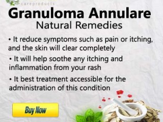 Herbal Supplement for Granuloma Annulare