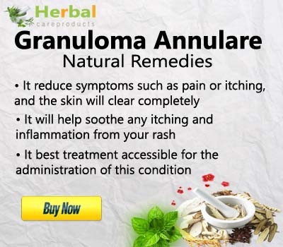 herbal-supplement-for-granuloma-annulare-big-0