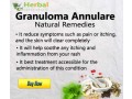 herbal-remedies-for-granuloma-annulare-small-0