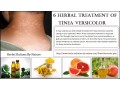 natural-remedies-for-tinea-versicolor-with-helpful-home-ingredients-small-0